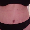 11 days after - Type 1 Diabetic