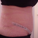 11 days after - Type 1 Diabetic