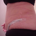 11 days after - Type 1 Diabetic