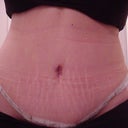 11 days after - Type 1 Diabetic