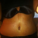 9 days post op