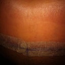 9 days post op incision