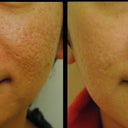 Fractional CO2 Laser