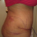 Day after surgery