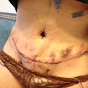 Post op day 1
