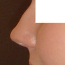 my nose in profile before any surgery.