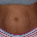 hello stretchmark city!...the belly