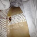 just after surgery