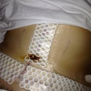 just after surgery