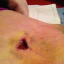 My poor BB. Very bruised.