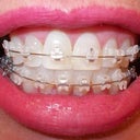 Approx 5 wks photo before visit for adjustment is tomorrow.  Got braces 11/7/12 follow-up 12/12/12.  I see no movement to left and right.  I feel like they are the same or more bunched.