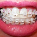 5th wk before adjustment:  Pull my neighboring teeth to the left and right a lot, till the front ones sit inside, not on the other teeth.  It's making me crazy.