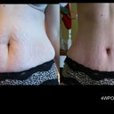 Before/After 4WPO