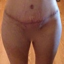 another frontal view 18 days PO
