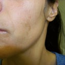neck cheek chin.. these are after 4 months on Clavaris. the doc said it would be a year before they would go away totally