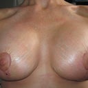 One month post op...still swollen; too much muscle manipulation (work related).