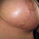 Left Breast. Scars are healing nicely : )