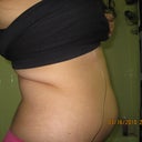 1 day before surgery