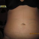 1 day post op