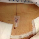 11 hrs post op.
