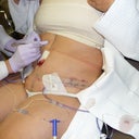 Day 3 (getting belly button bandages removed at PS's office)