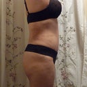 Side (8 weeks post)