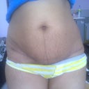 3month scar is slowly fading but there is still lot of strech mark.