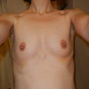breasts before