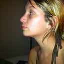 1 week after, my eyes were bruised for about 3 weeks. The bump is gone!
