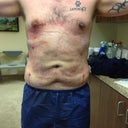 Standing up directly after procedure: Front
