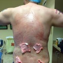 Standing up directly after procedure: Back
