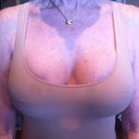 Breasts being held by Spanx on Day 46 Post Op.
