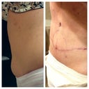 6 mos post op tt and just had touch up lipo done