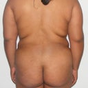  24 Years Old Female Treated For Lipodistrofy On Her Back ( Fat Exces On Her Back)