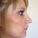 Side View Before Surgery