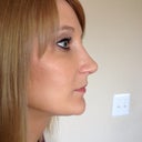 Side View After Surgery - 8 wks