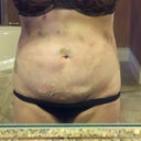 2 days post op smart/vibro lipo