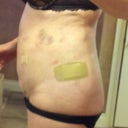 2 days post op smart/vibro lipo