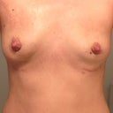 4 weeks post-op