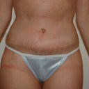 16 days post op