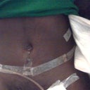 3 days post op
