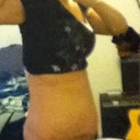 Still very swollen... Seroma not totally drained. Side view with no compression garment.