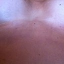My incisions POST-OP 1 Month