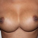 Pre-Op Symmastia