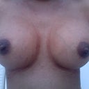 6 weeks Post-Op front view 2