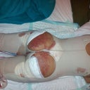 Swollen bruised with foams