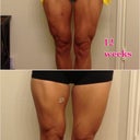 This is for the why are my legs so big ladies. The swelling drains south.  As you can see at day 25 you can't see any definition in my left leg...like none. And NO, I didn't flip out about it either, it's temporary. Now 12 weeks & just a few workouts later....check it out!!!