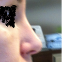 Profile - 17 days post op