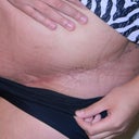 1 month PO scar