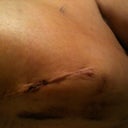 1 wk post op - nasty, I only hope all this chopping will disappear!
